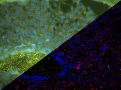 BreastCancer_FFPE_SplitScreen