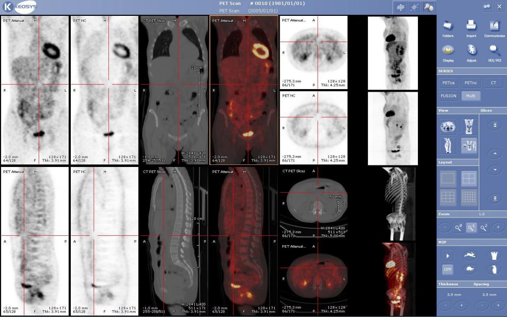 What does the PET-CT show? | Tissuepathology.com