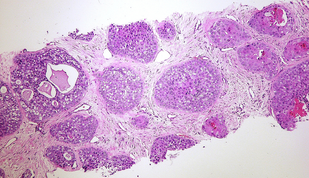 FDA Approves First Liquid Biopsy Test For Use In Non Small Cell Lung Cancer Tissuepathology