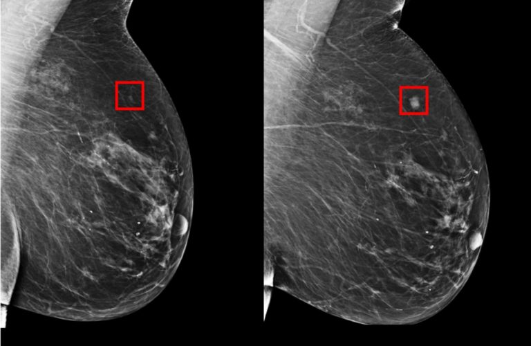 MIT AI tool can predict breast cancer up to 5 years early, works ...