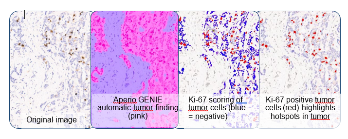 Ki-67 hotspot tumor analysis 